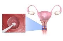 Cervical Cancer Screening and Abnormal Pap Smear Management