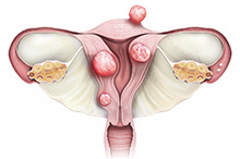 Uterine Fibroids