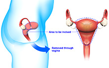 Hysterectomy