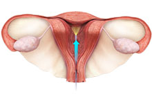 Hysteroscopy