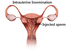 Infertility Evaluation and Treatment