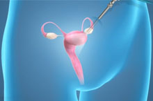 Laparoscopy